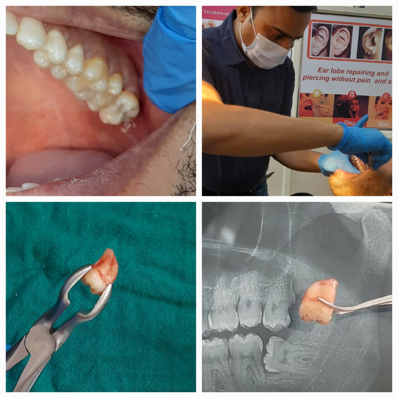 Wisdom Tooth Surgery